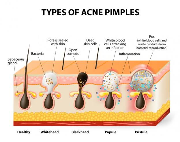 Acne-Causing Bacteria