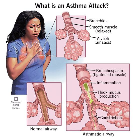 Asthma