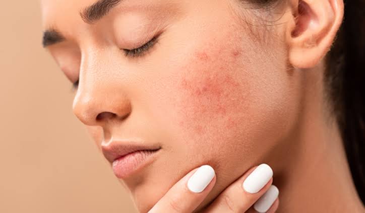 How relate Acne-Causing Bacteria and Beneficial Skin Oils