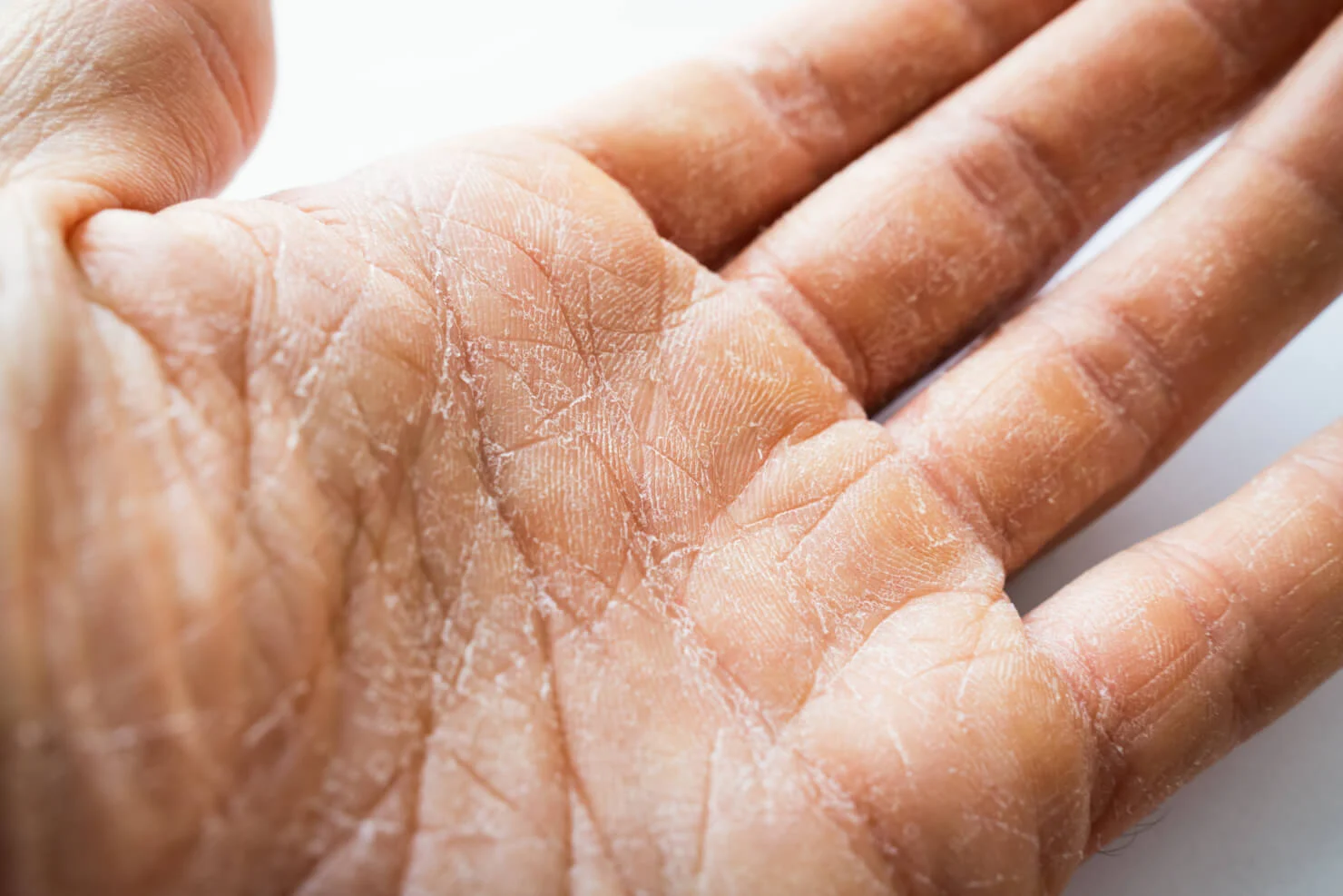 Goodbye to Dry Peeling Skin: Home Remedies