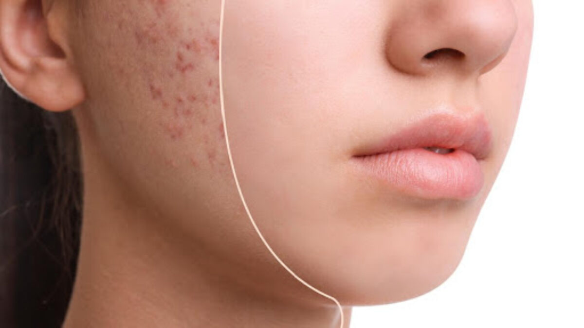 Pimples No More: Your Path to Clear, Healthy Skin